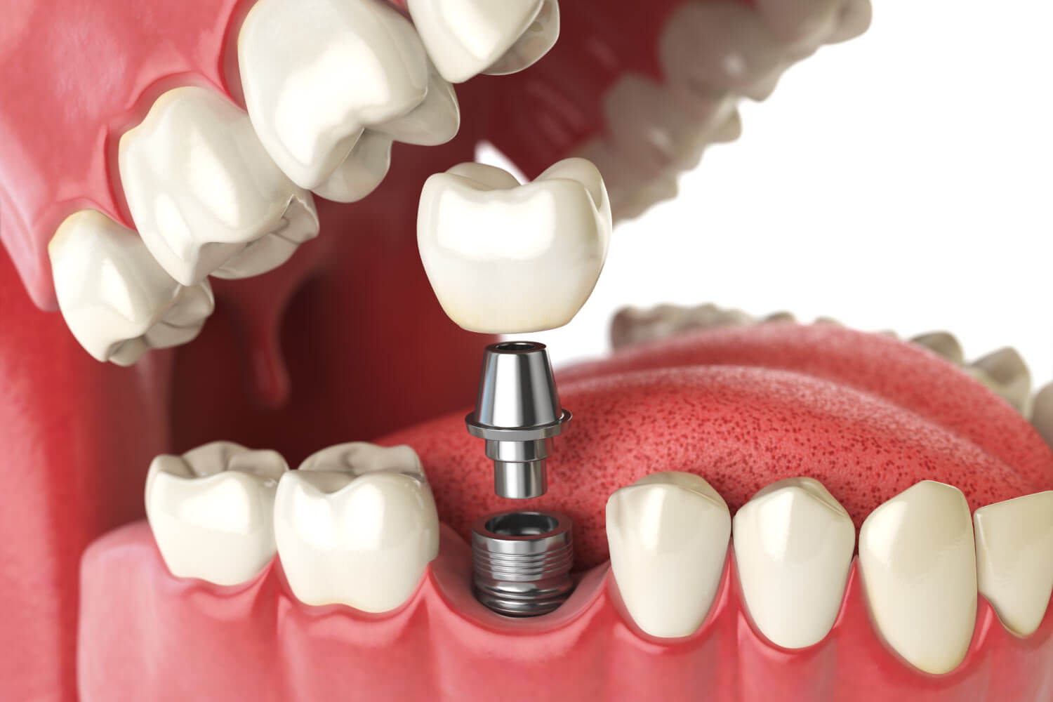 Closeup of a dental implant to replace a missing tooth