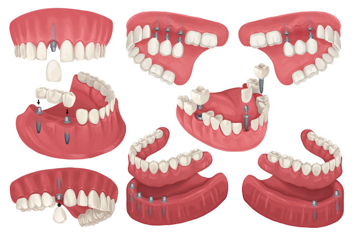 dental implants models