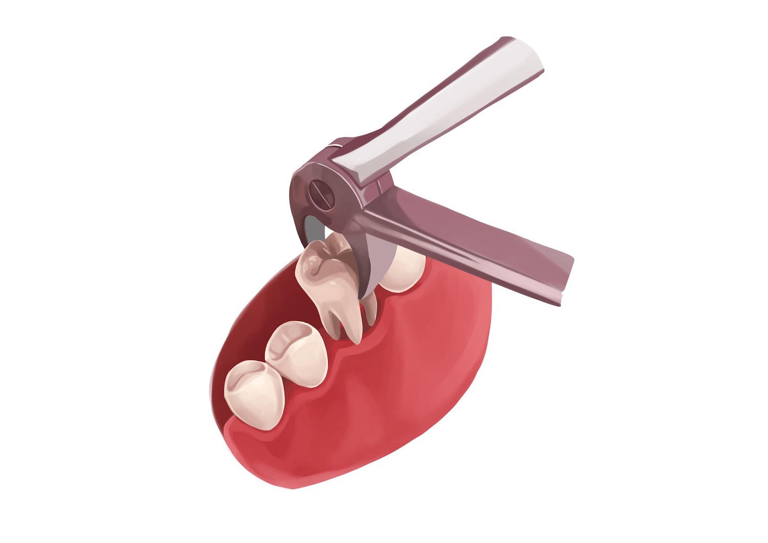 Illustration of special dental tools extracting a tooth
