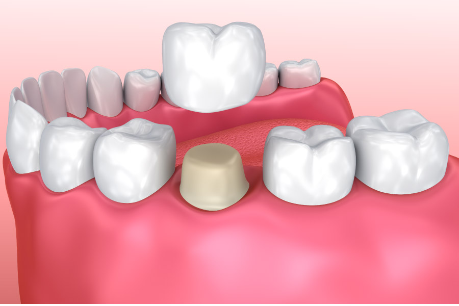 model of a dental crown